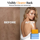 🔥Buy 2 Get 1 Free ✨Body Acne Soap for Clearer Skin